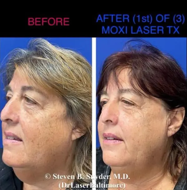 Laser facial before and after result 5 — Dermatology Laser Center & Medispa, Owings Mills, MD