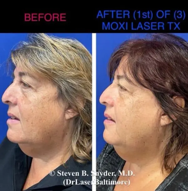 Laser facial before and after result 4 — Dermatology Laser Center & Medispa, Owings Mills, MD