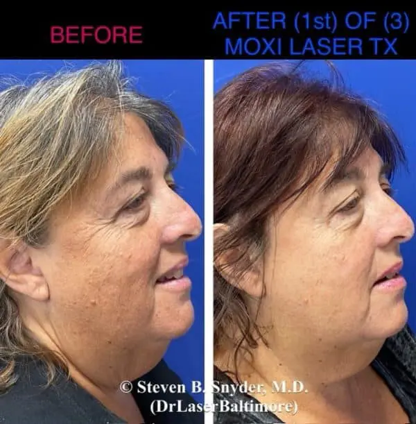 Laser facial before and after result 3 — Dermatology Laser Center & Medispa, Owings Mills, MD