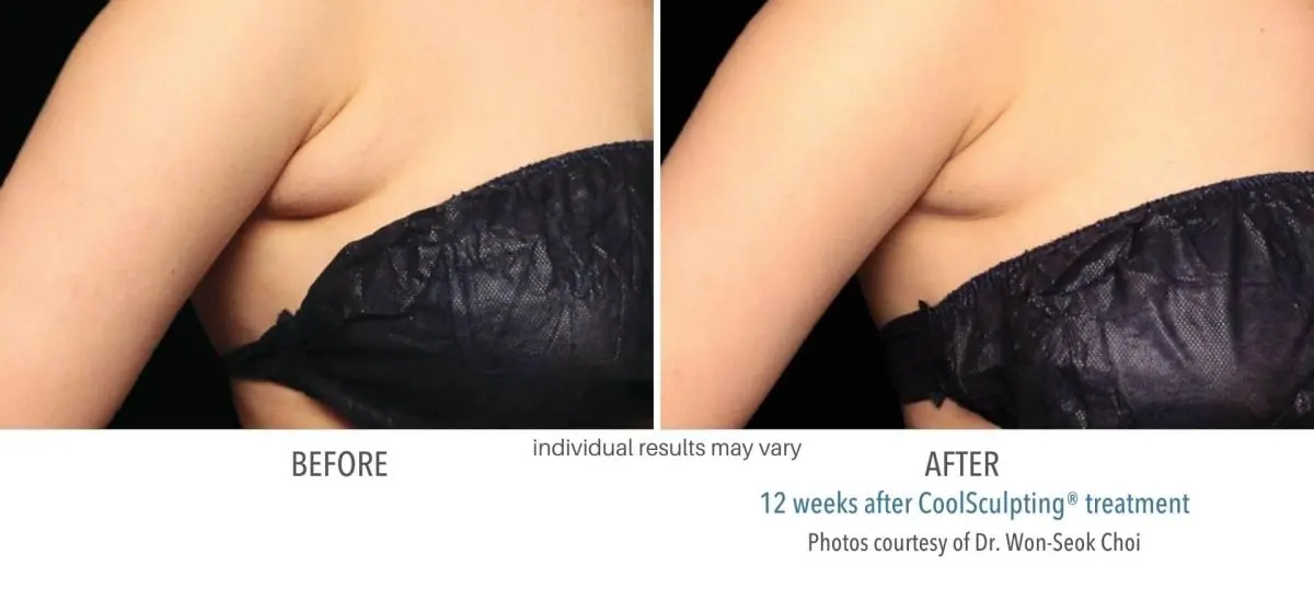 coolsculpting_before_and_after_Dermatology_Laser_Center_1