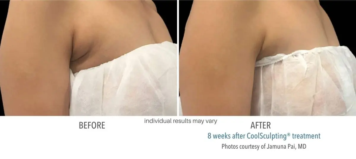 coolsculpting_before_and_after_Dermatology_Laser_Center_11