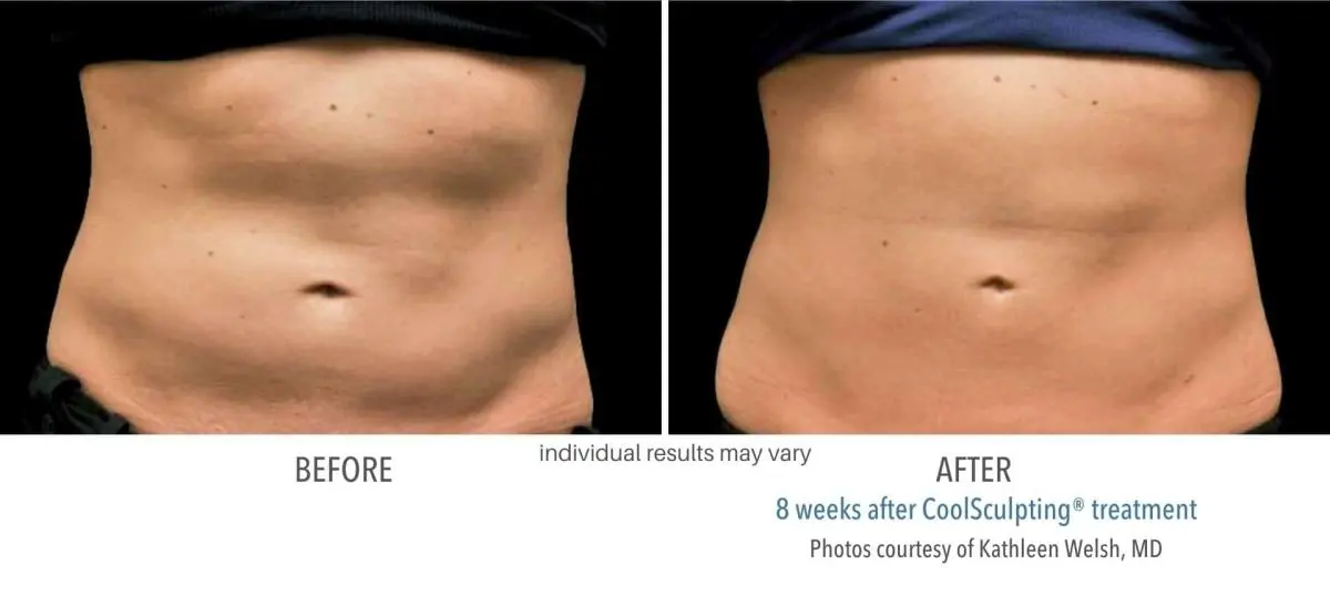 coolsculpting_before_and_after_Dermatology_Laser_Center_12
