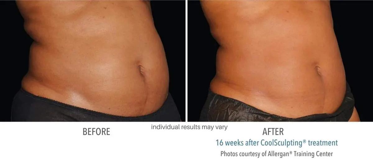 coolsculpting_before_and_after_Dermatology_Laser_Center_13