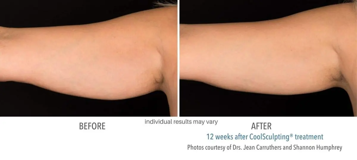 coolsculpting_before_and_after_Dermatology_Laser_Center_14