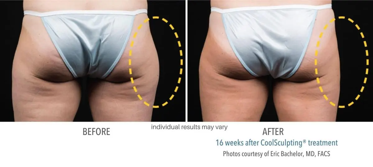 coolsculpting_before_and_after_Dermatology_Laser_Center_15