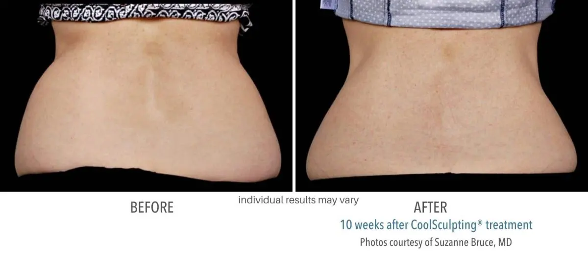 coolsculpting_before_and_after_Dermatology_Laser_Center_2