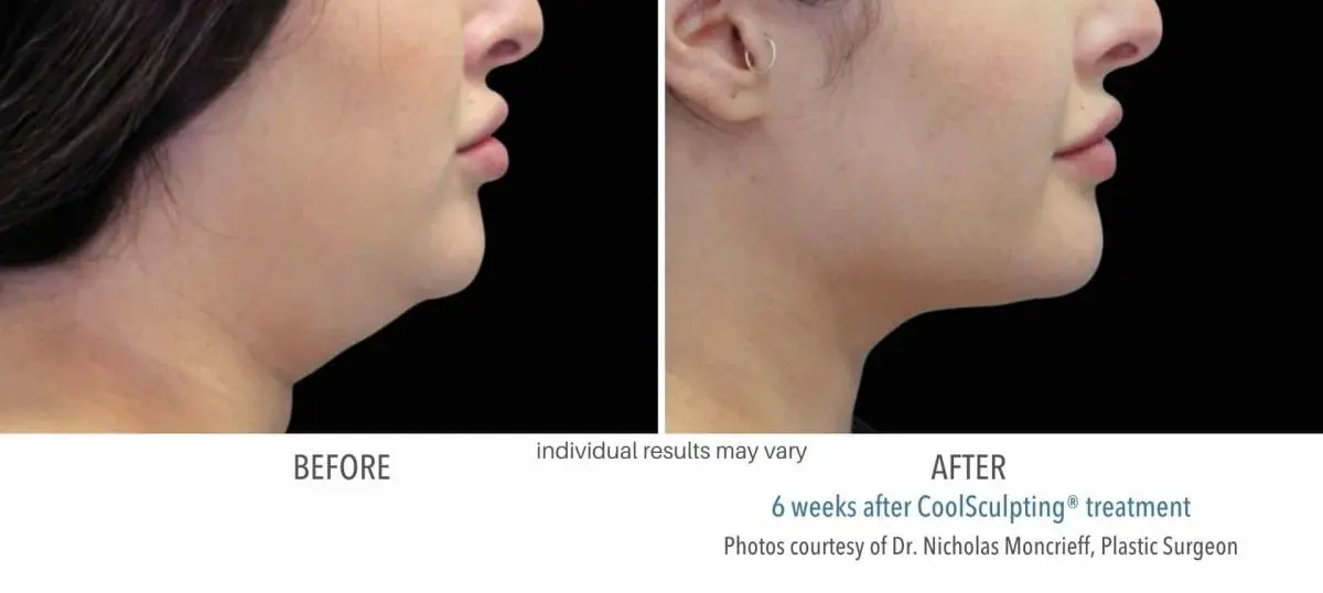 coolsculpting_before_and_after_Dermatology_Laser_Center_4