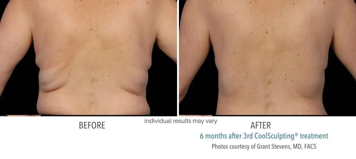 coolsculpting_before_and_after_Dermatology_Laser_Center_5
