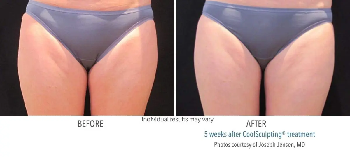 coolsculpting_before_and_after_Dermatology_Laser_Center_8