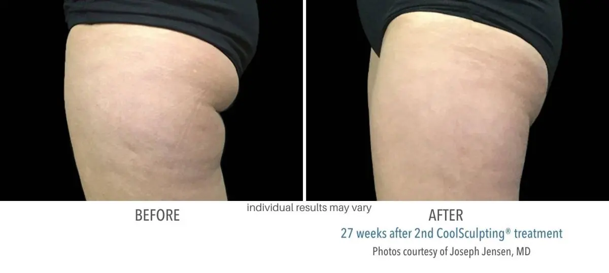 coolsculpting_before_and_after_Dermatology_Laser_Center_9