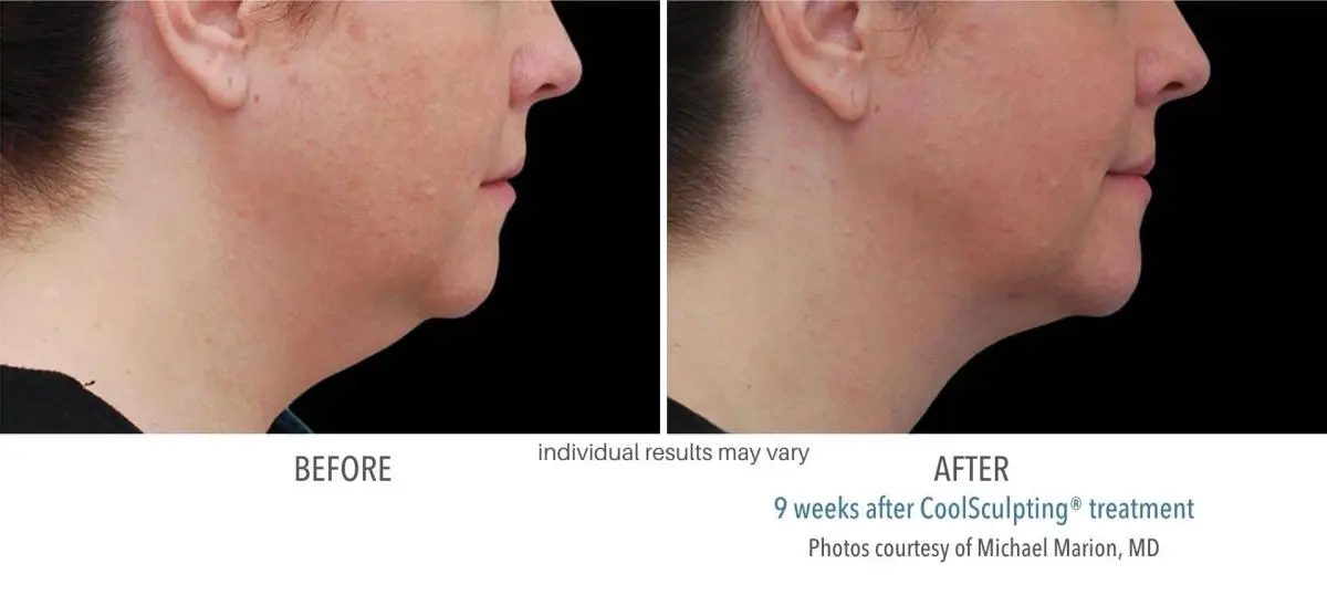 coolsculpting_before_and_after_owning_mills_1