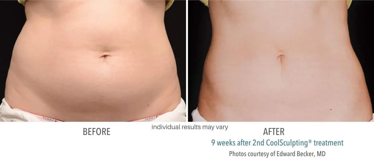 coolsculpting_before_and_after_owning_mills_3