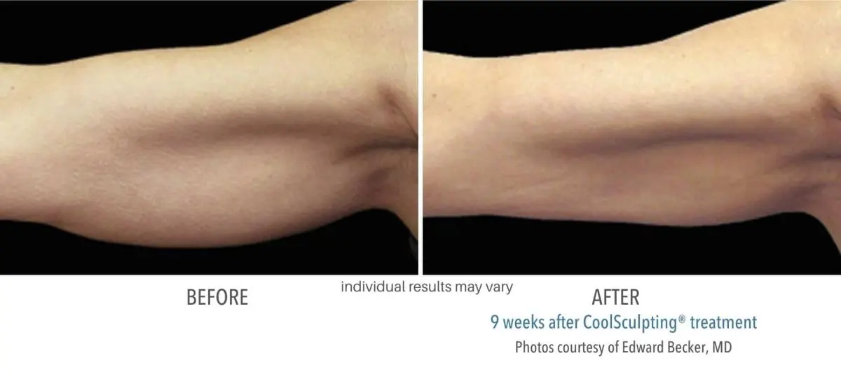 coolsculpting_before_and_after_owning_mills_4