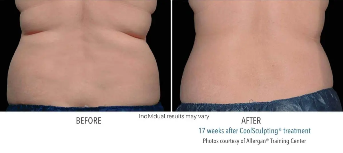 coolsculpting_before_and_after_owning_mills_5