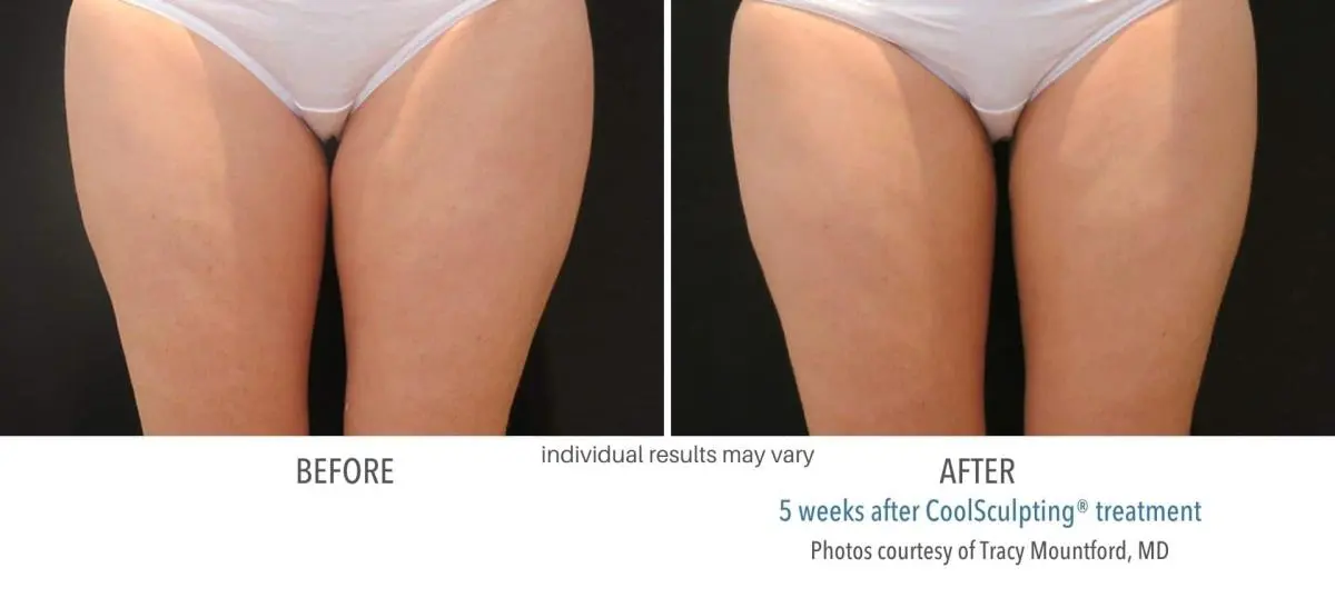 coolsculpting_before_and_after_owning_mills_6