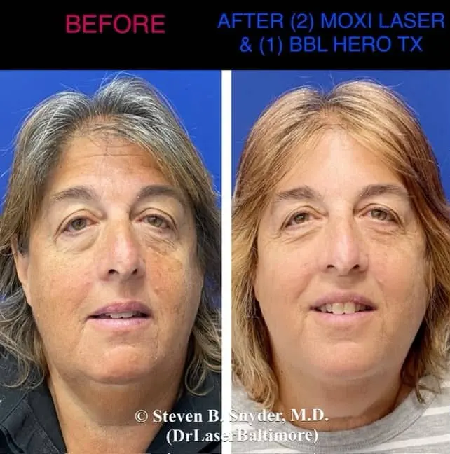 Laser skin resurfacing before and after result 1 — Dermatology Laser Center & Medispa, Owings Mills, MD