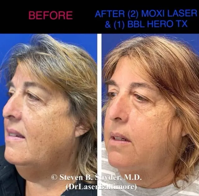 Laser skin resurfacing before and after result 2 — Dermatology Laser Center & Medispa, Owings Mills, MD