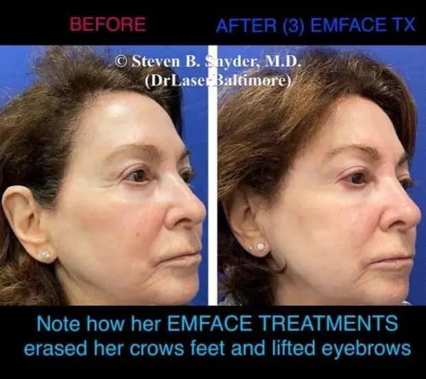 EMface before and after result 8 — Dermatology Laser Center & Medispa, Owings Mills, MD