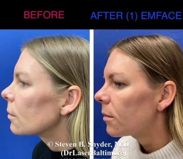 EMface before and after result 7 — Dermatology Laser Center & Medispa, Owings Mills, MD