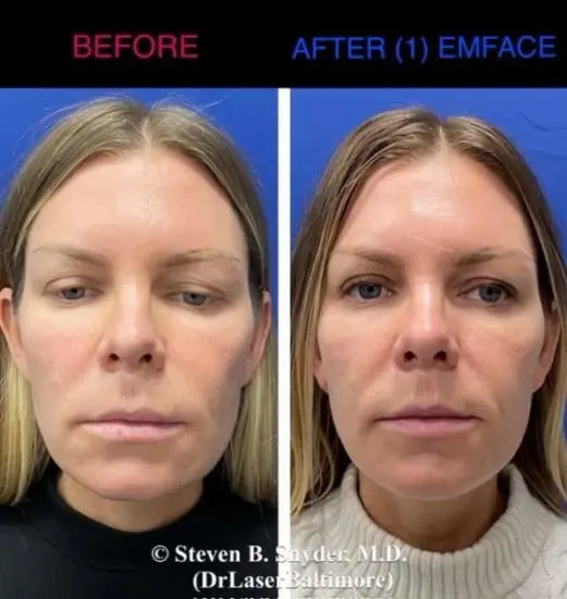 EMface before and after result 6 — Dermatology Laser Center & Medispa, Owings Mills, MD
