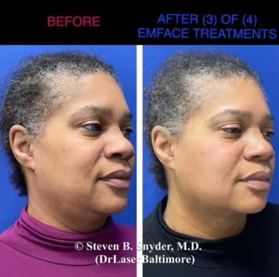 EMface before and after result 5 — Dermatology Laser Center & Medispa, Owings Mills, MD