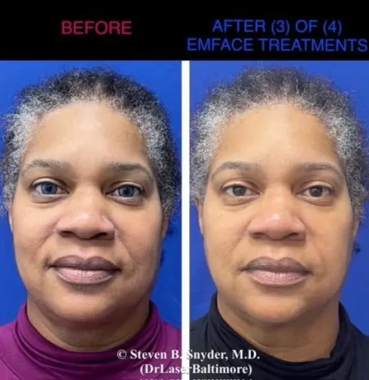 EMface before and after result 4 — Dermatology Laser Center & Medispa, Owings Mills, MD
