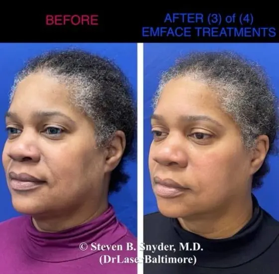 EMface before and after result 3 — Dermatology Laser Center & Medispa, Owings Mills, MD