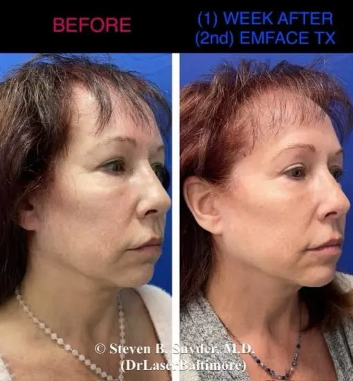 EMface before and after result 2 — Dermatology Laser Center & Medispa, Owings Mills, MD