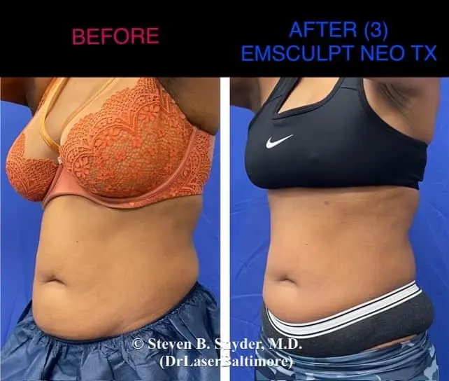 Emsculpt NEO Before and After: Real Patient Results — Dermatology Laser Center & Medispa, Owings Mills, MD