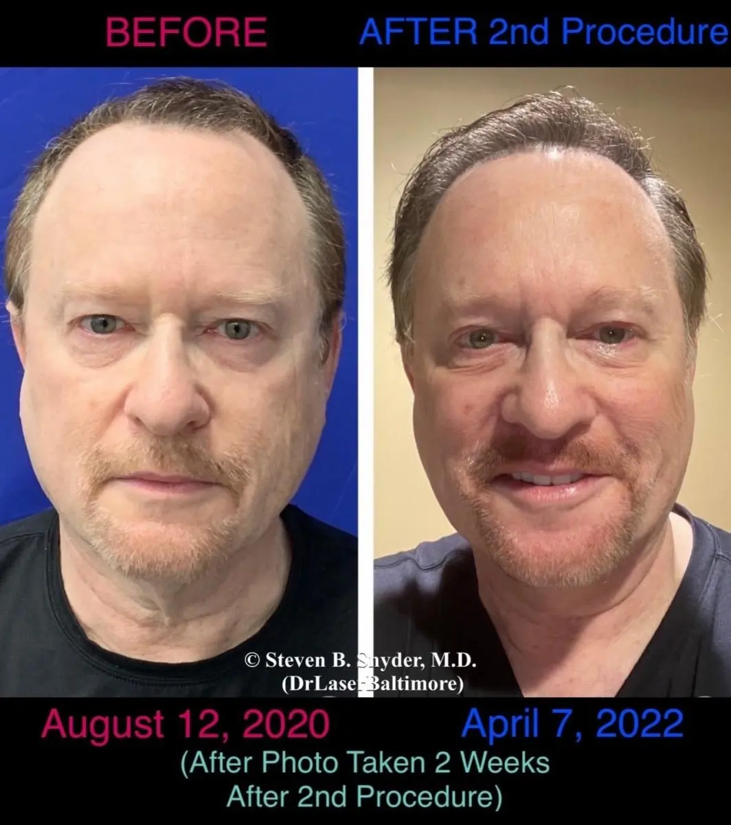 morpheus-8-before-and-after-Laser-Doc-MD