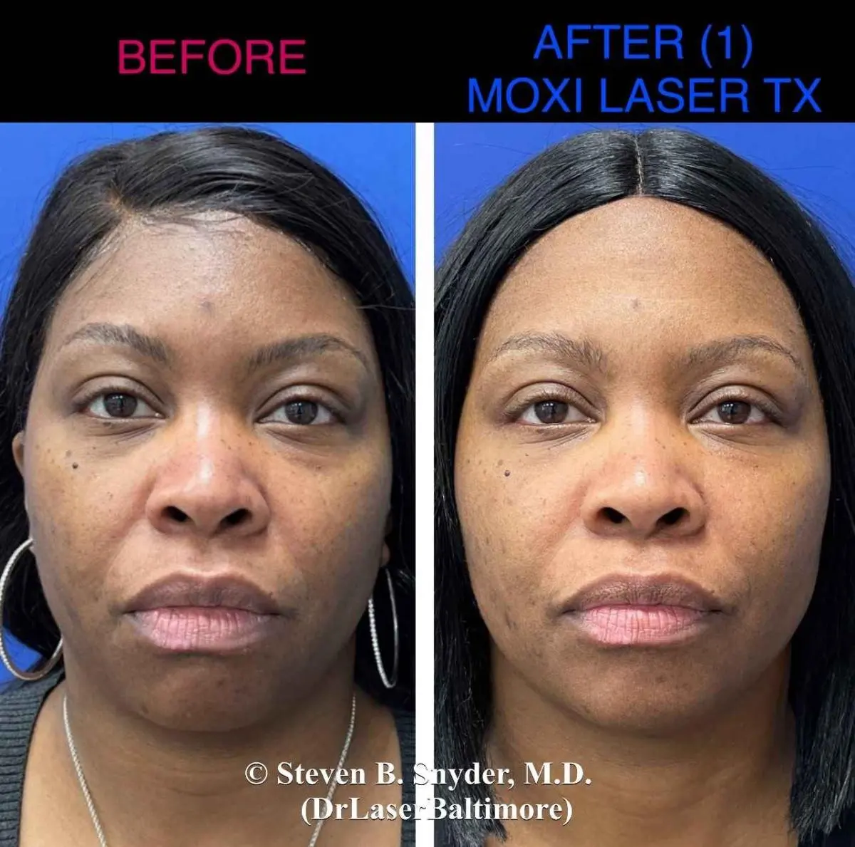 moxi-before-and-after-1_11zon