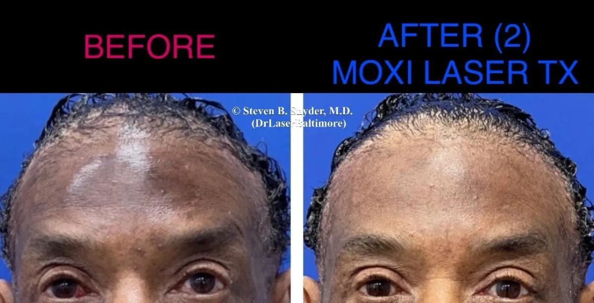 moxi-before-and-after-2