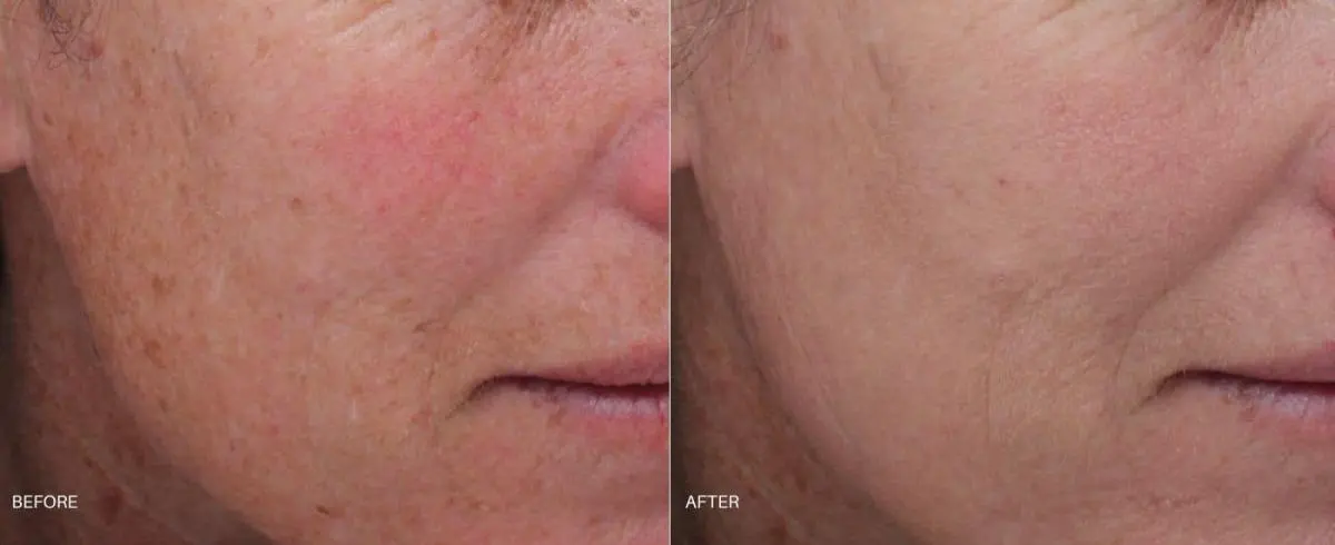 moxi-laser-skin-resurfacing-before-and-after-1