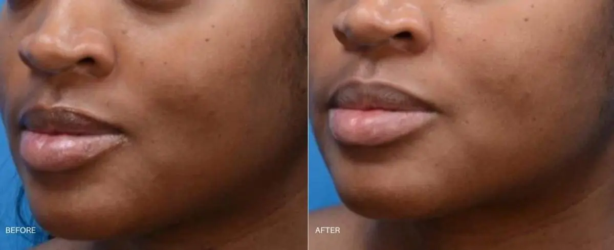 moxi-laser-skin-resurfacing-before-and-after-2