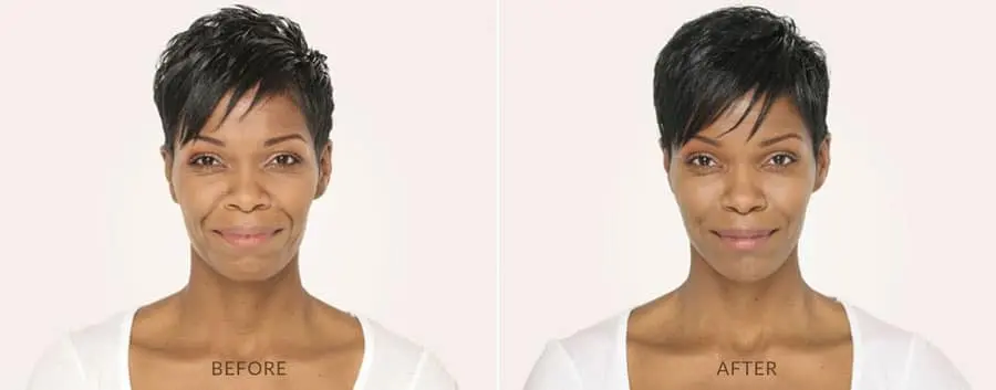 radiesse-before-and-after-treatment-1